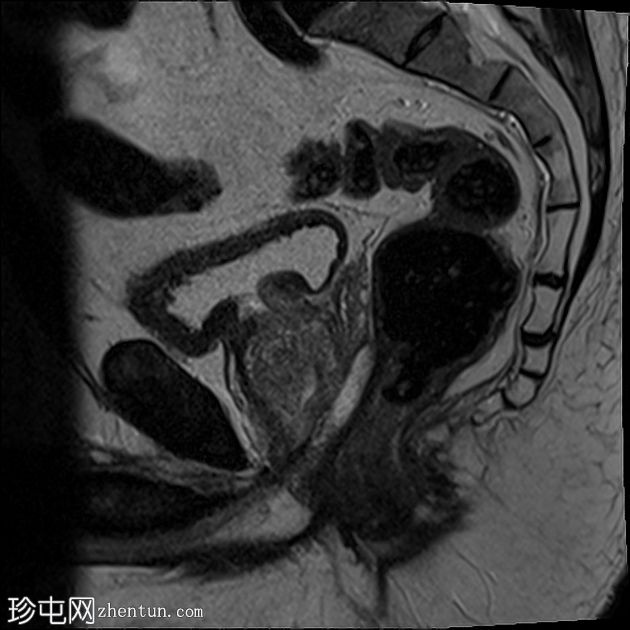 膀胱平滑肌瘤