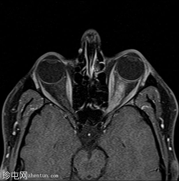 视神经炎伴神经周炎