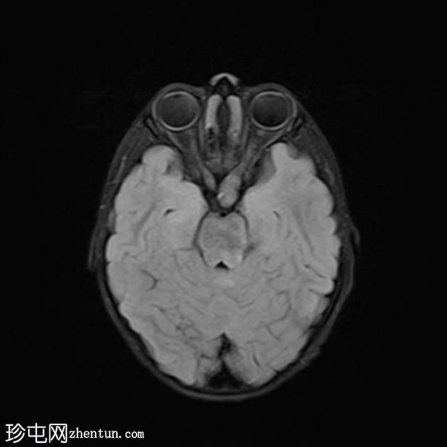 神经纤维瘤病1型