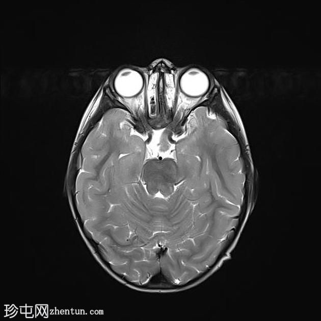 神经纤维瘤病1型