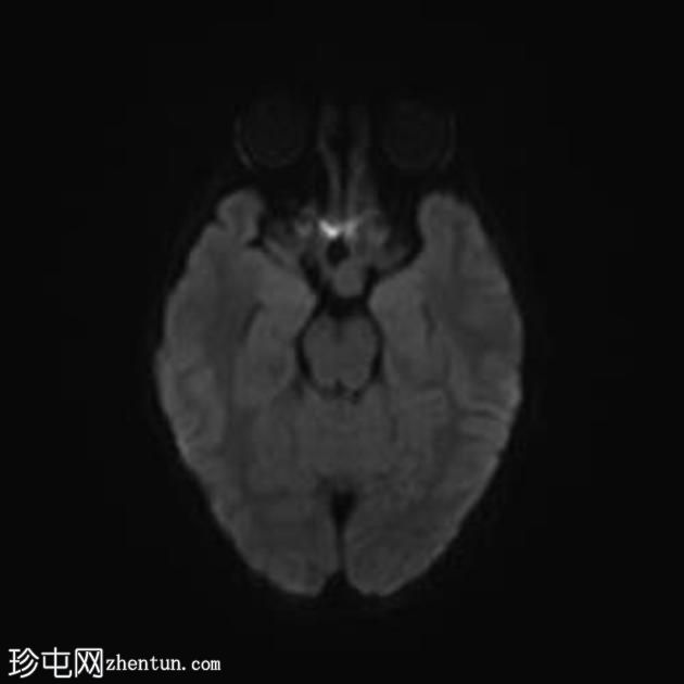 神经纤维瘤病1型