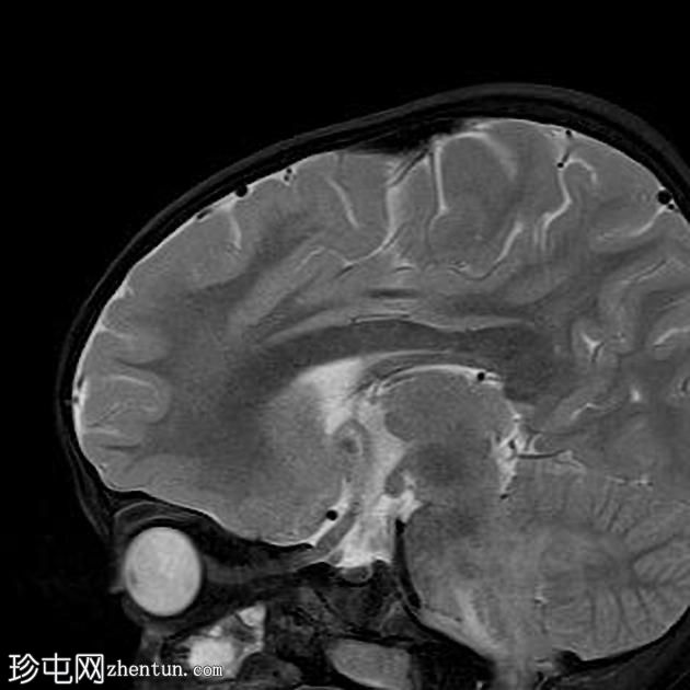 神经纤维瘤病1型