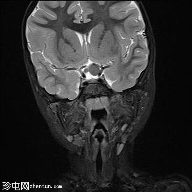 神经纤维瘤病1型