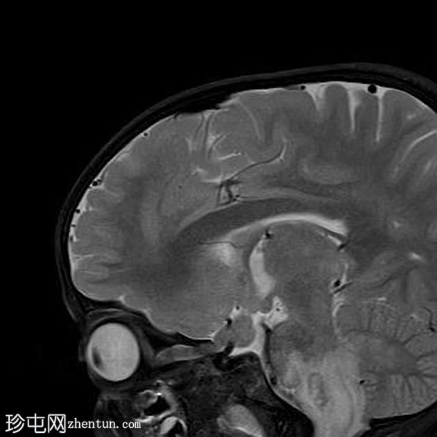 神经纤维瘤病1型