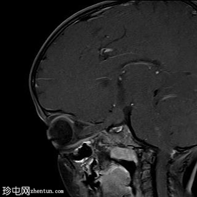 神经纤维瘤病1型