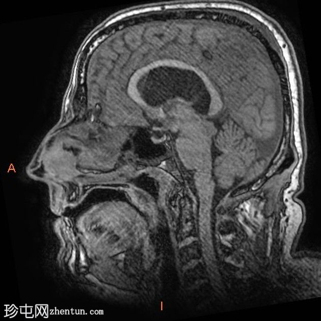 阻塞等密度胶质囊肿