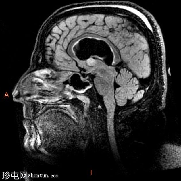 阻塞等密度胶质囊肿