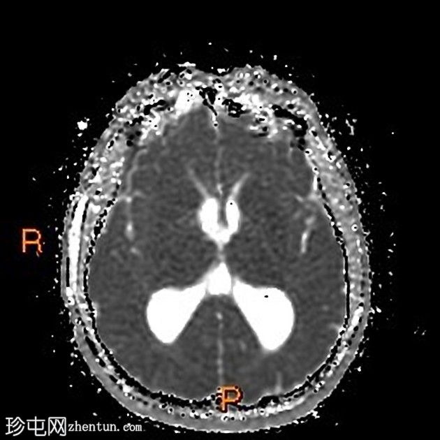 阻塞等密度胶质囊肿