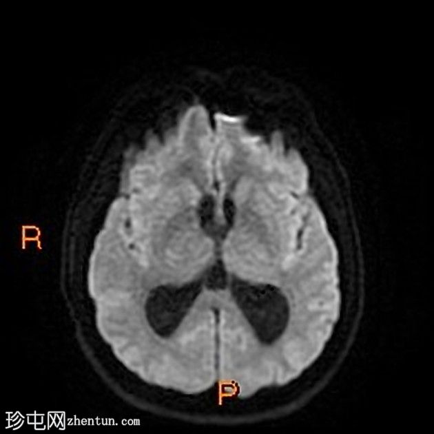 阻塞等密度胶质囊肿