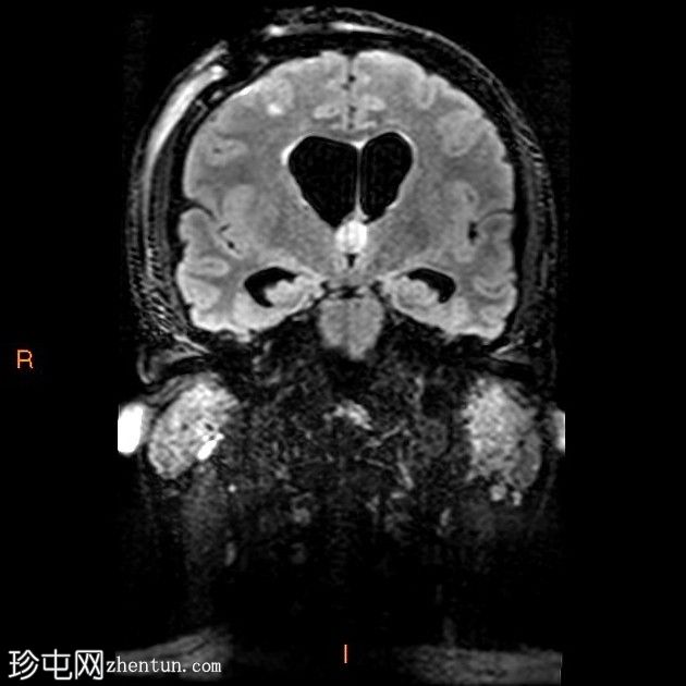 阻塞等密度胶质囊肿