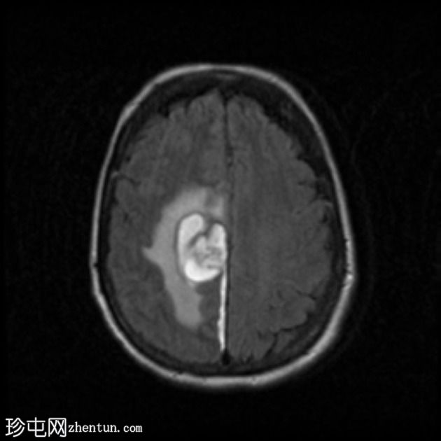 脑淀粉样血管病继发大叶出血