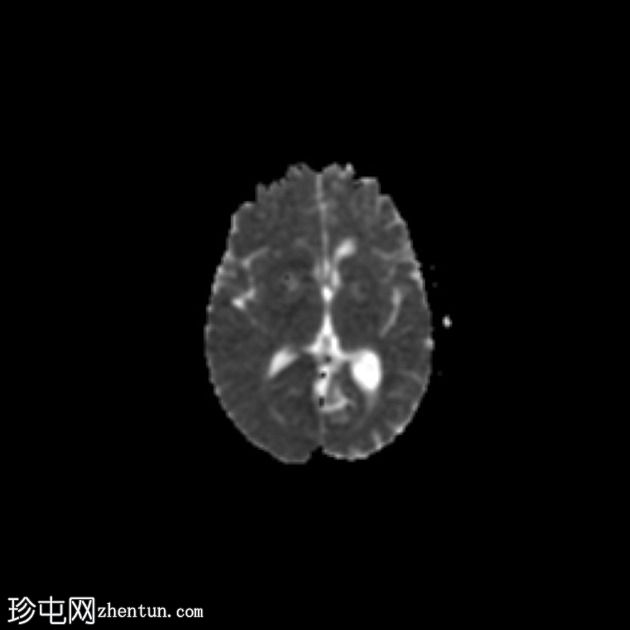 脑淀粉样血管病继发大叶出血