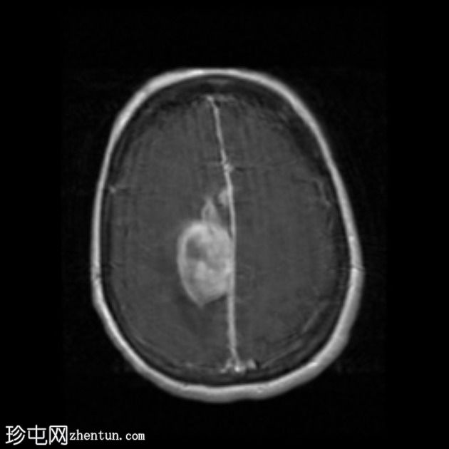 脑淀粉样血管病继发大叶出血