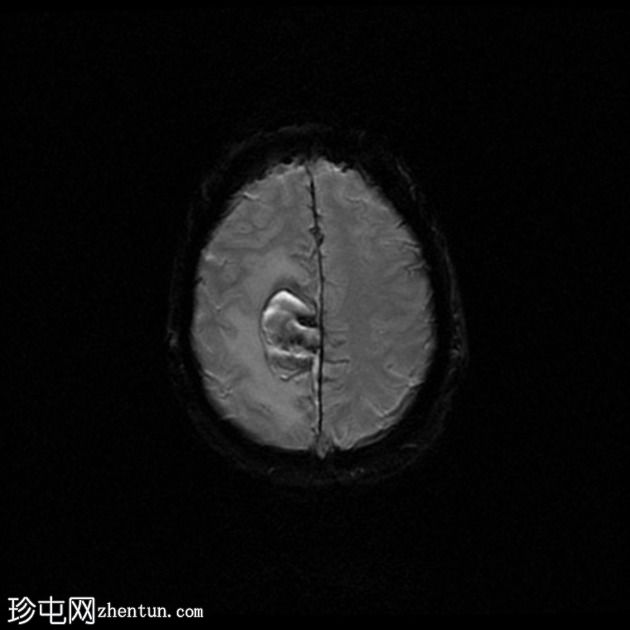 脑淀粉样血管病继发大叶出血