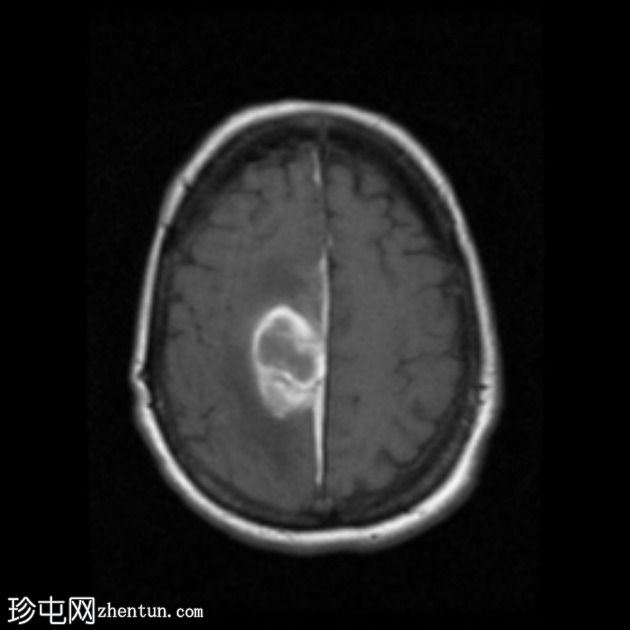 脑淀粉样血管病继发大叶出血