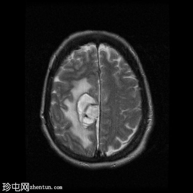 脑淀粉样血管病继发大叶出血