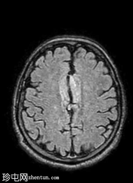 胼胝体周脂肪瘤伴奇静脉大脑前动脉