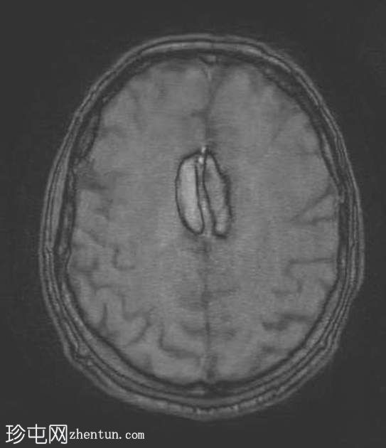胼胝体周脂肪瘤伴奇静脉大脑前动脉