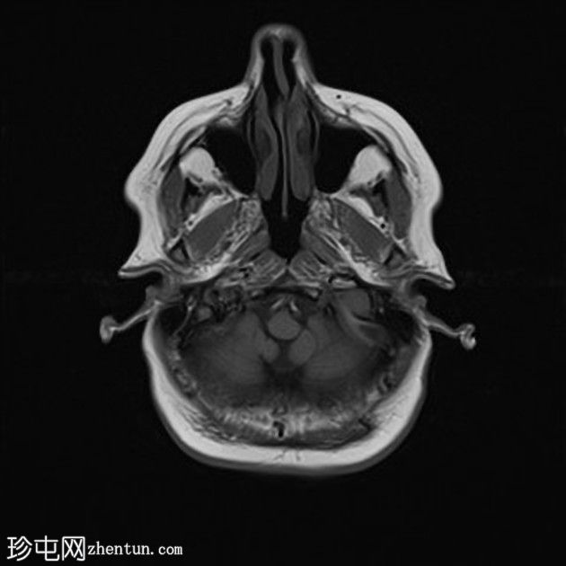 脑静脉血流缓慢