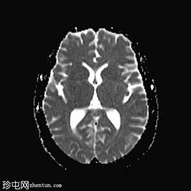 脑静脉血流缓慢