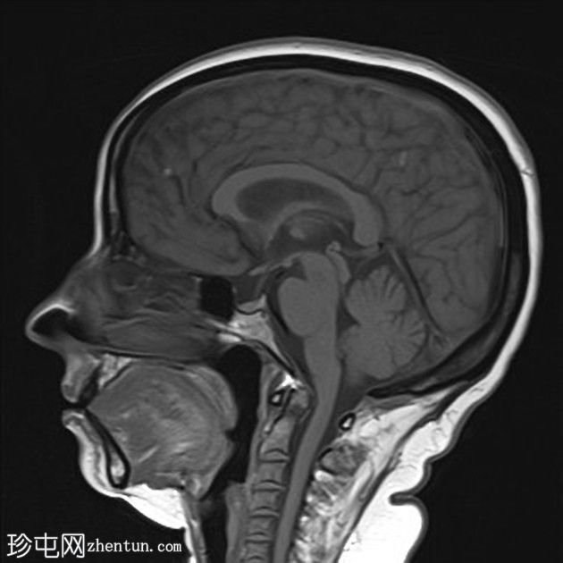 脑静脉血流缓慢