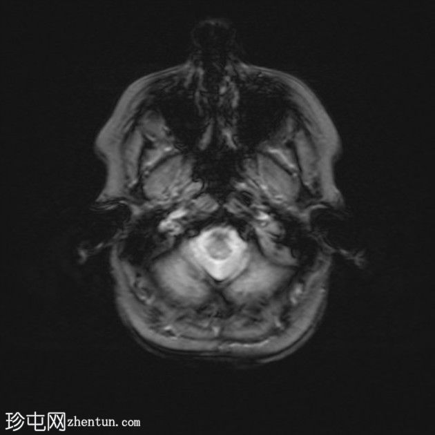 脑静脉血流缓慢