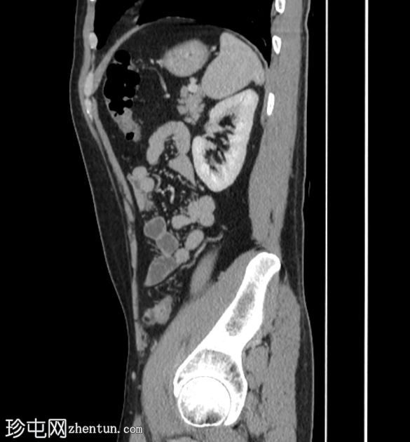 肠脂垂炎 ( epiploic appendagitis )