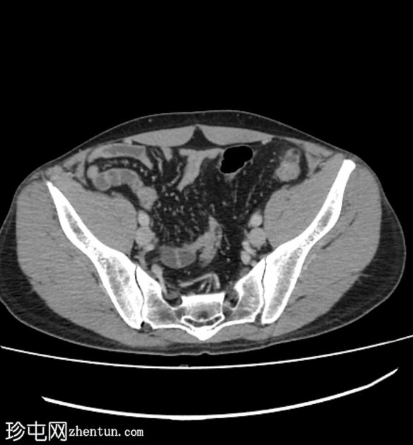 肠脂垂炎 ( epiploic appendagitis )