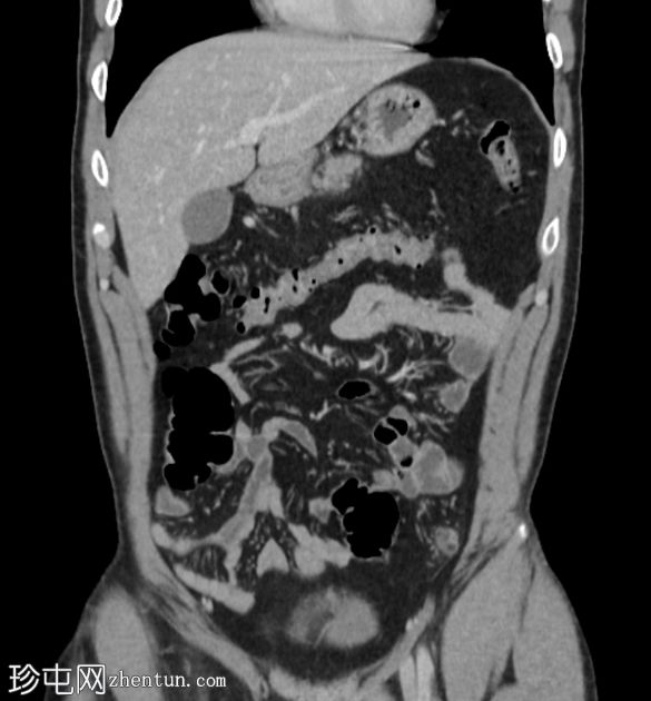 肠脂垂炎 ( epiploic appendagitis )