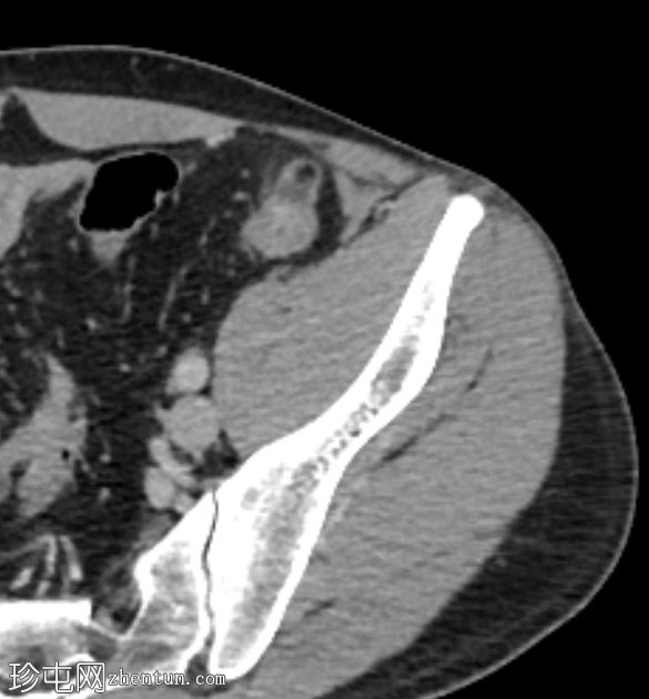 肠脂垂炎 ( epiploic appendagitis )