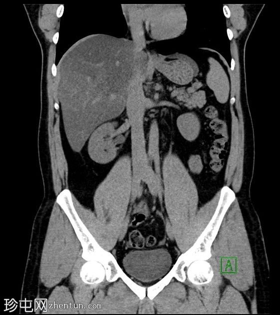 肠脂垂炎，类似急性阑尾炎