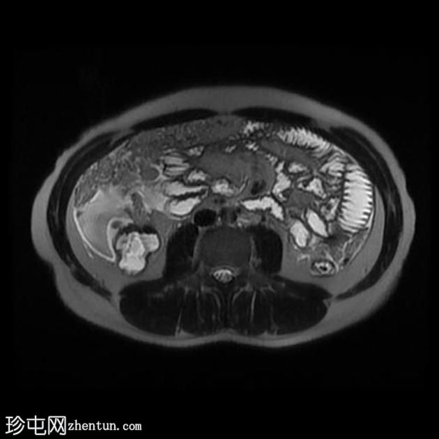 腹膜结核