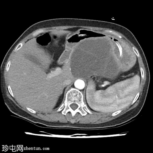 粘液囊性胰腺肿瘤