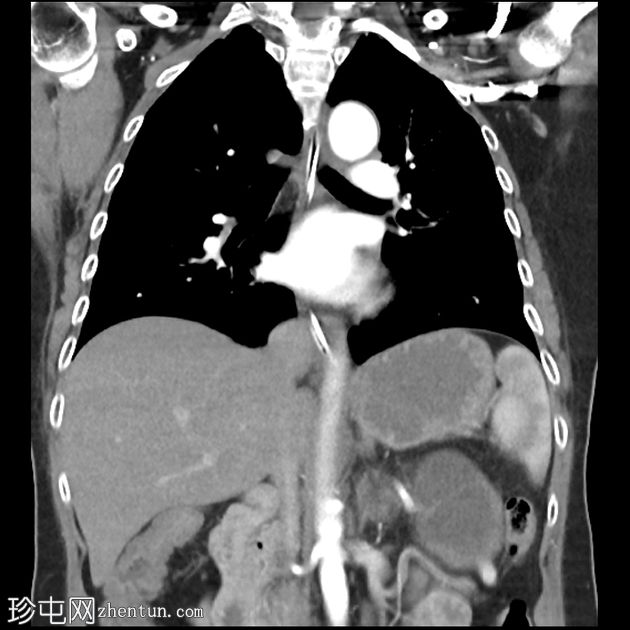 粘液囊性胰腺肿瘤