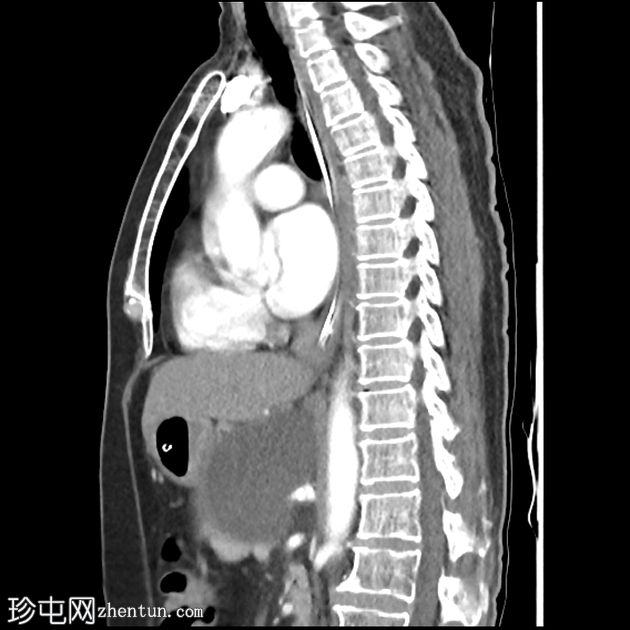 粘液囊性胰腺肿瘤