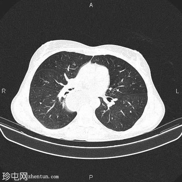 贲门失弛缓症