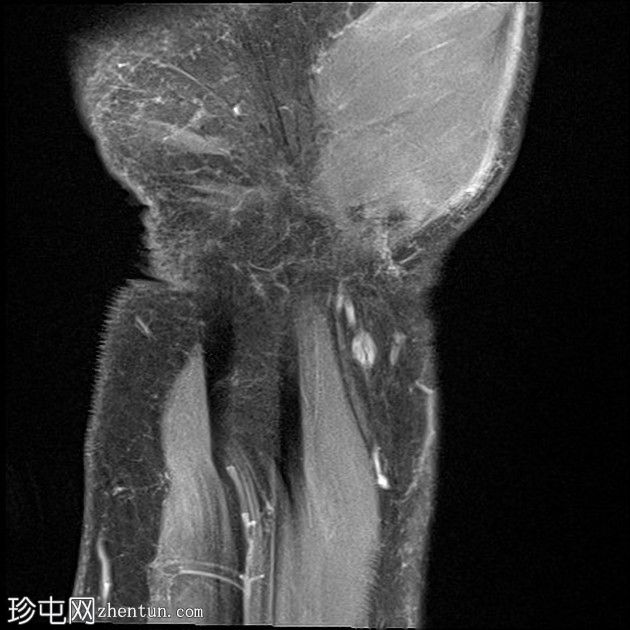 外伤性神经瘤:正中神经裂