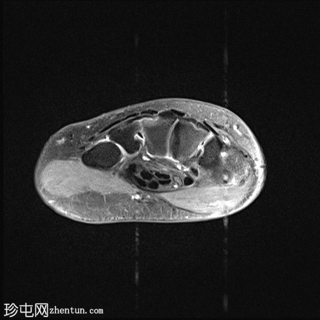 外伤性神经瘤:正中神经裂