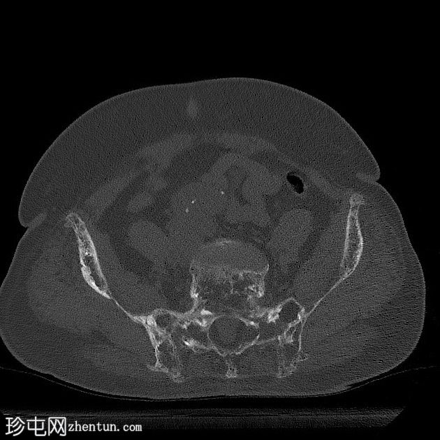 Paget病伴无移位髋臼骨折