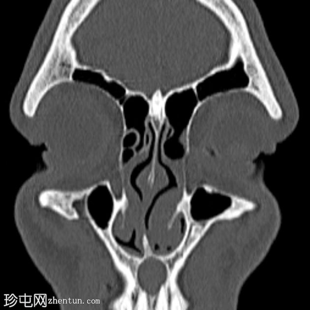 鼻腭管囊肿(NPDC)