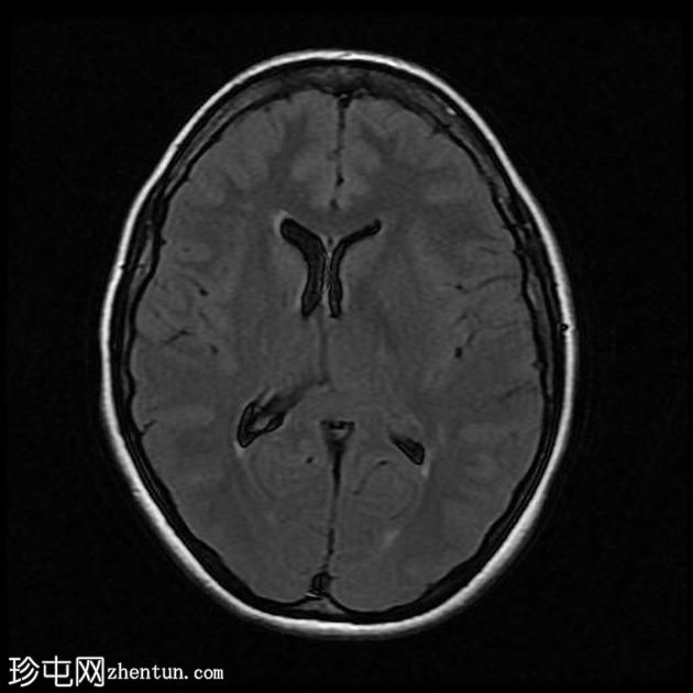 中颅窝脑膜瘤