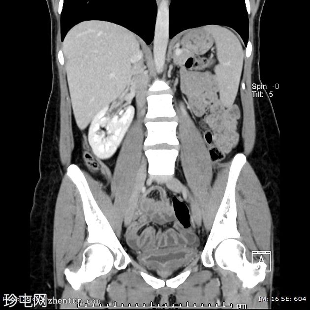 交叉融合肾异位 - E型