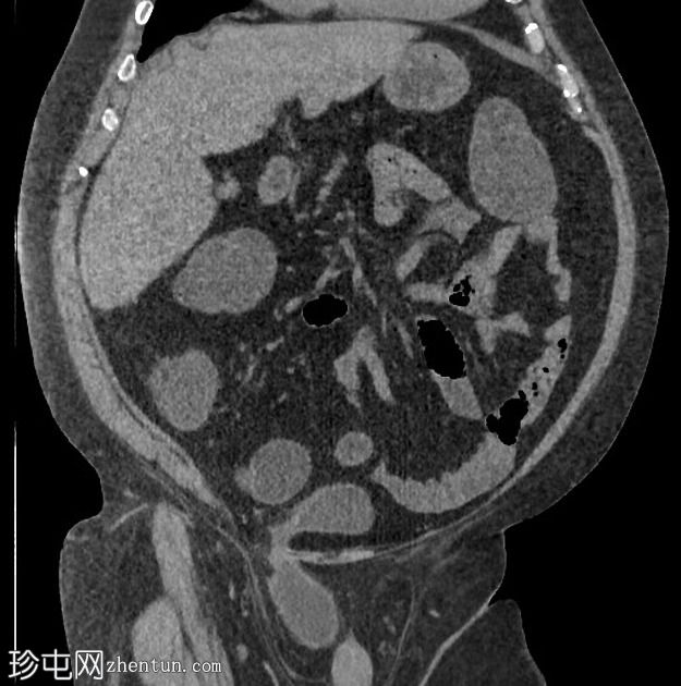 膀胱疝