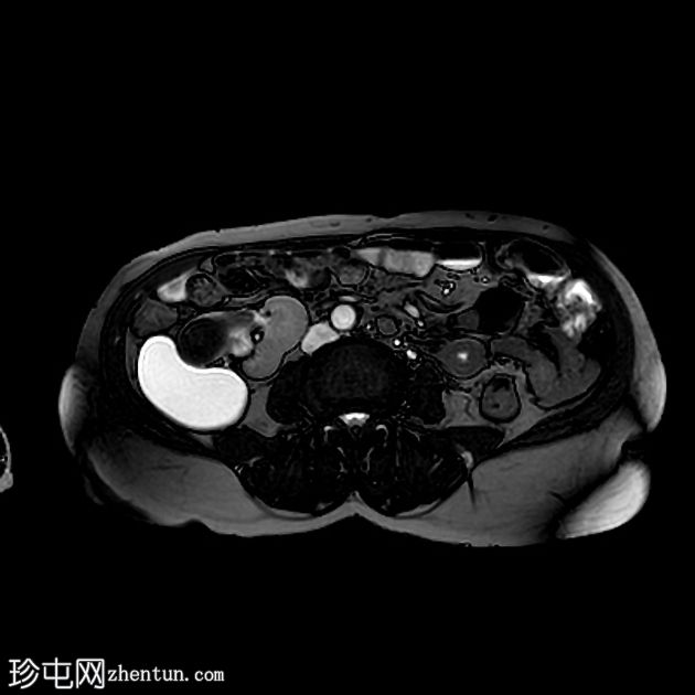 双收集系统与梗阻结石