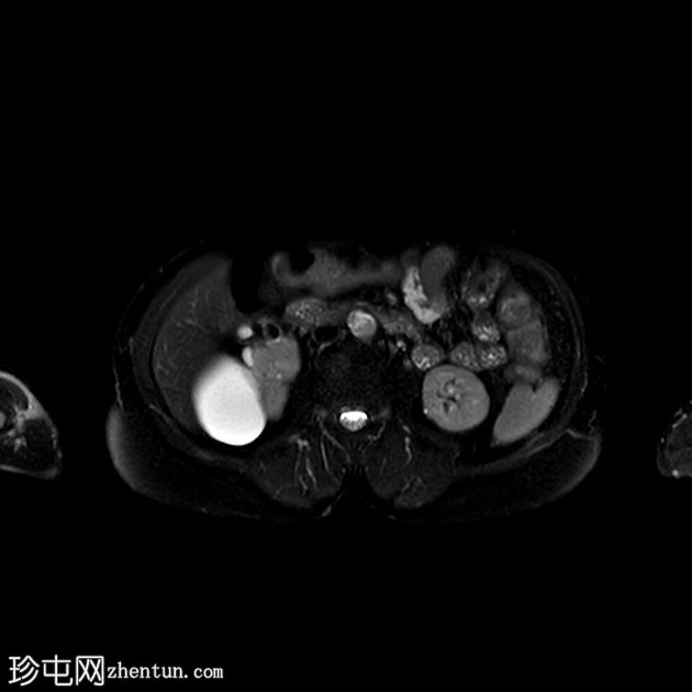 双收集系统与梗阻结石