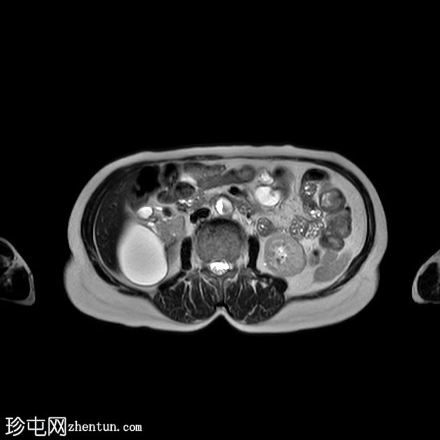 双收集系统与梗阻结石