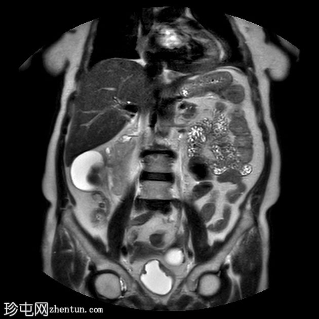 双收集系统与梗阻结石