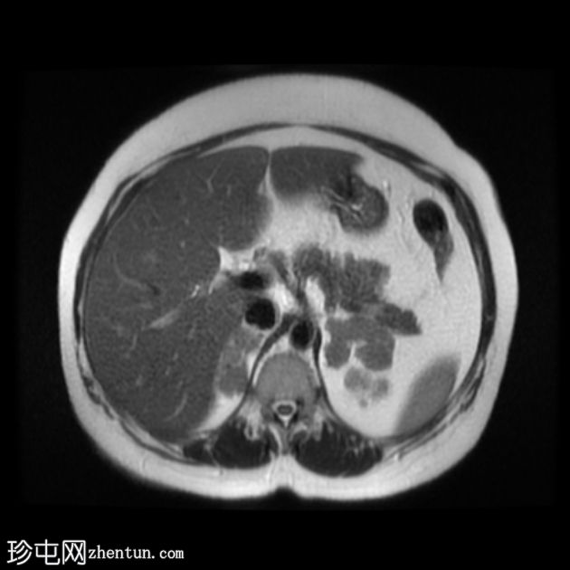 肾上腺大结节样增生