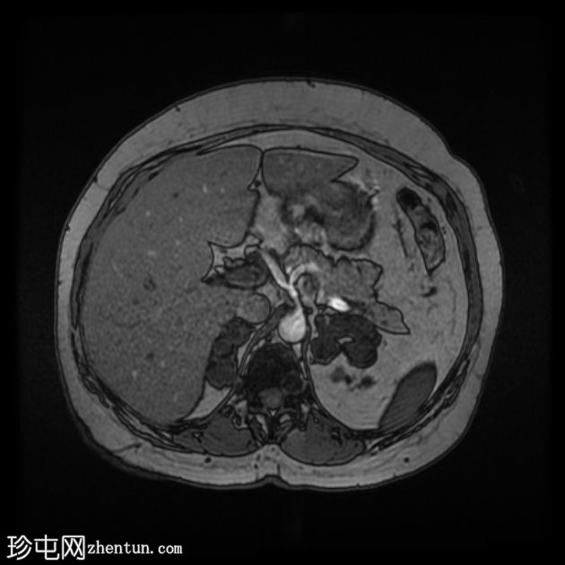 肾上腺大结节样增生