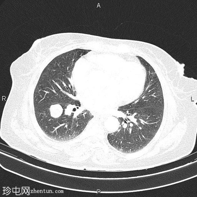 转移性局部浸润性肾细胞癌